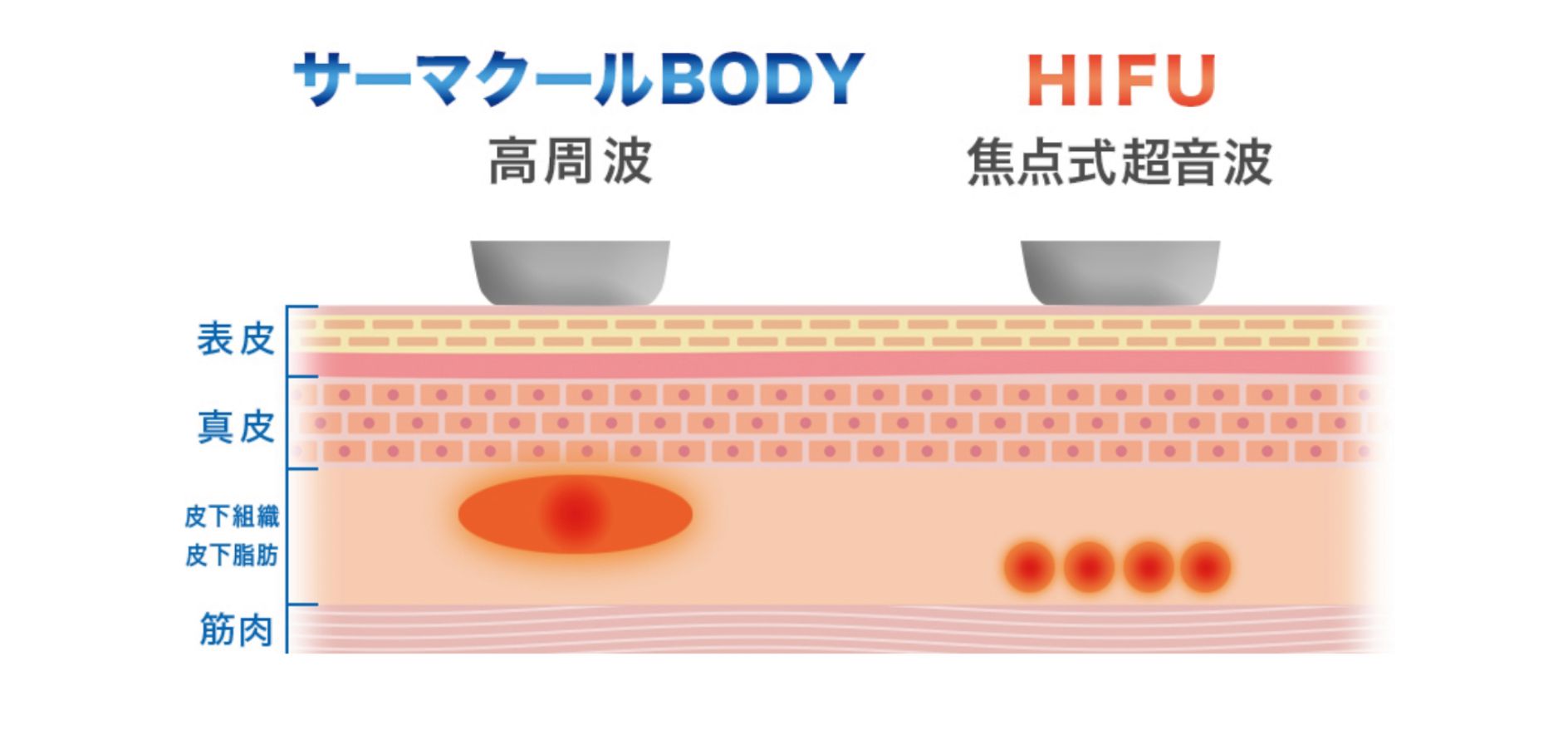 HIFUエネルギーの深さ（サーマクールBODYと比較）の図