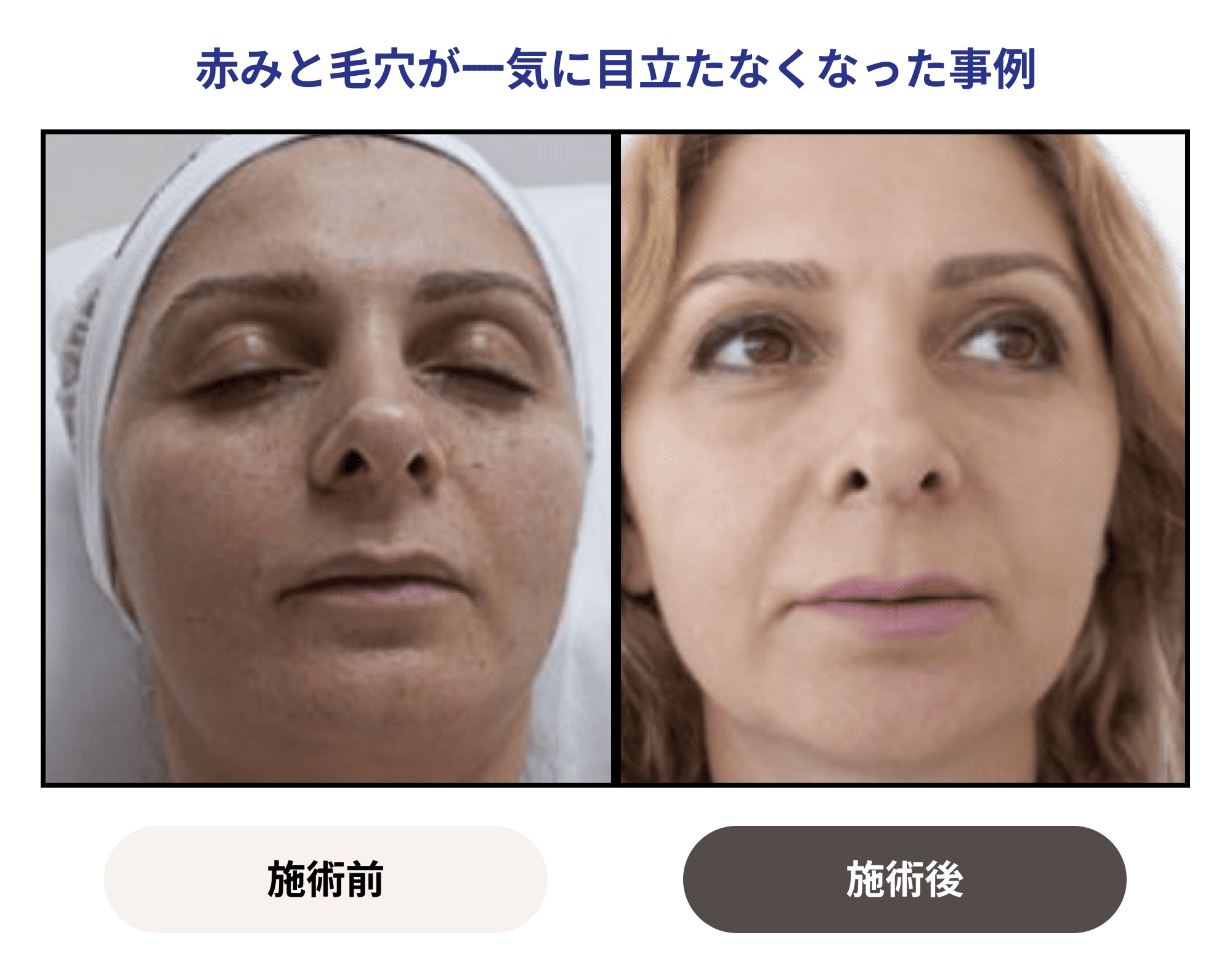 ROSEDEMERの症例写真