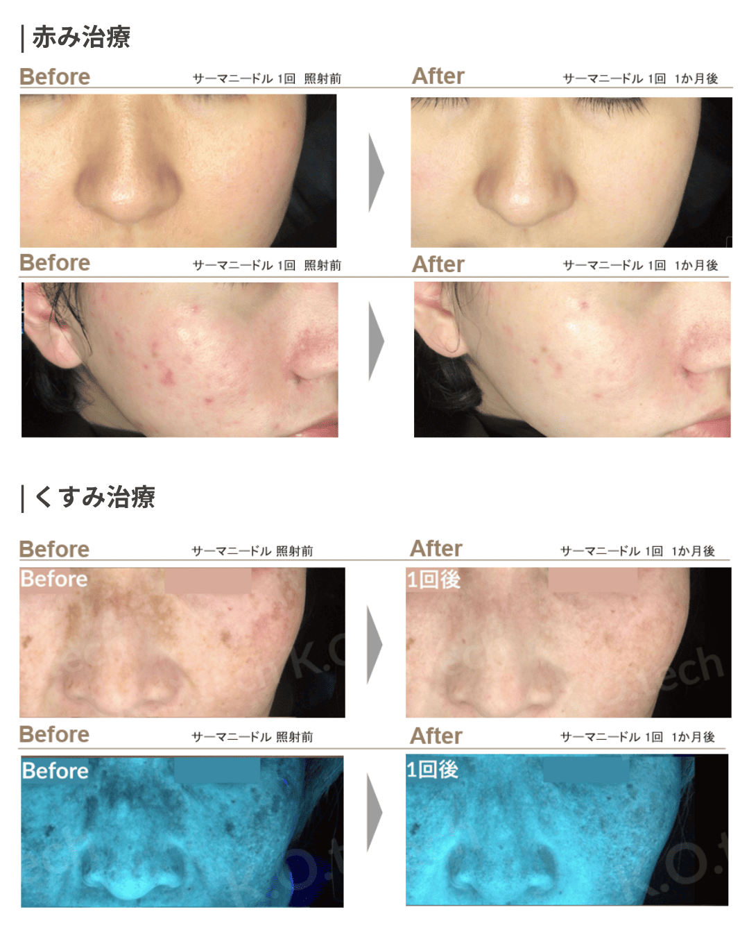 サーマニードルの症例写真