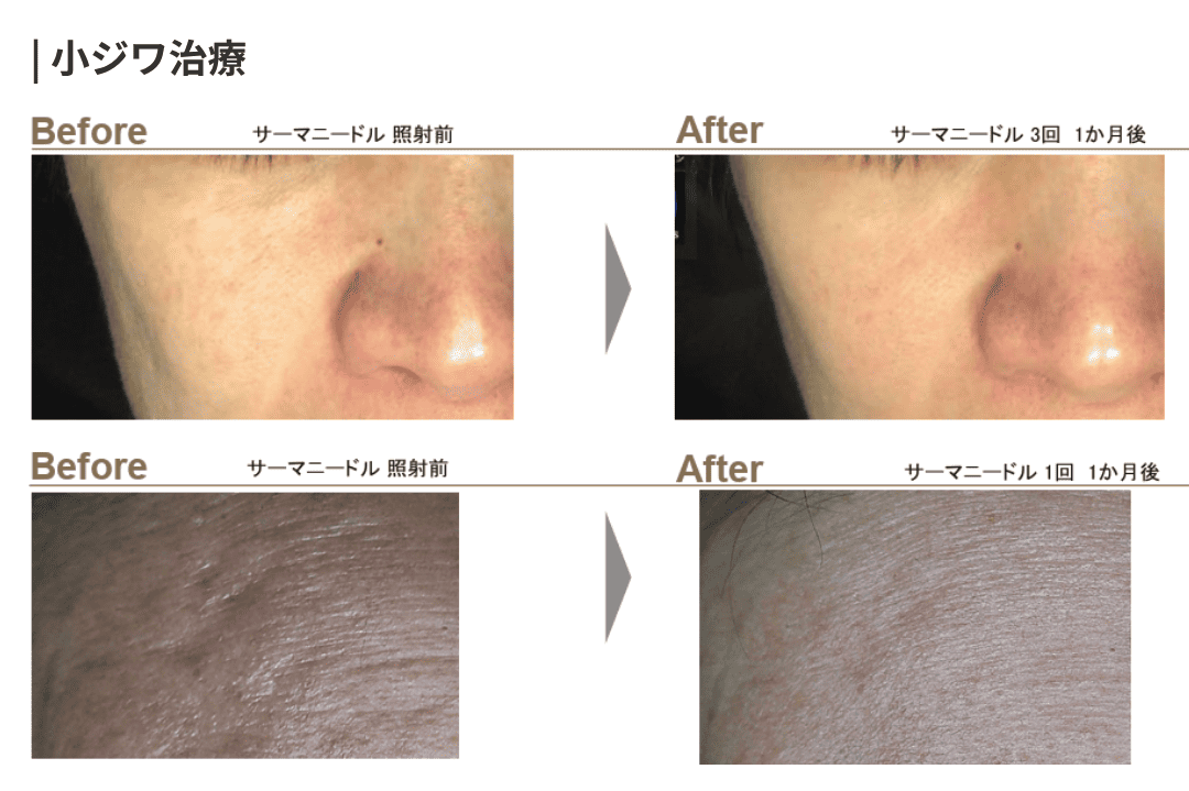 サーマニードルの症例写真