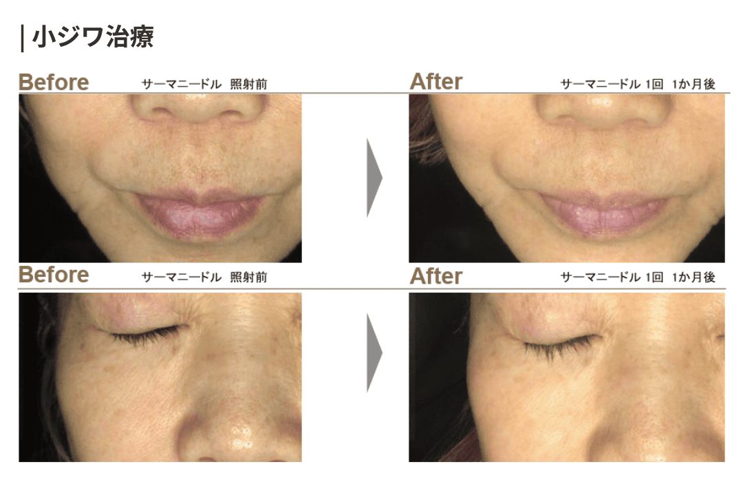 サーマニードルの症例写真