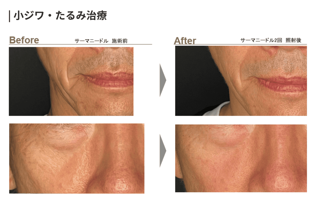 サーマニードルの症例写真