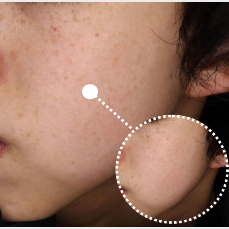 フォトフェイシャル 施術後