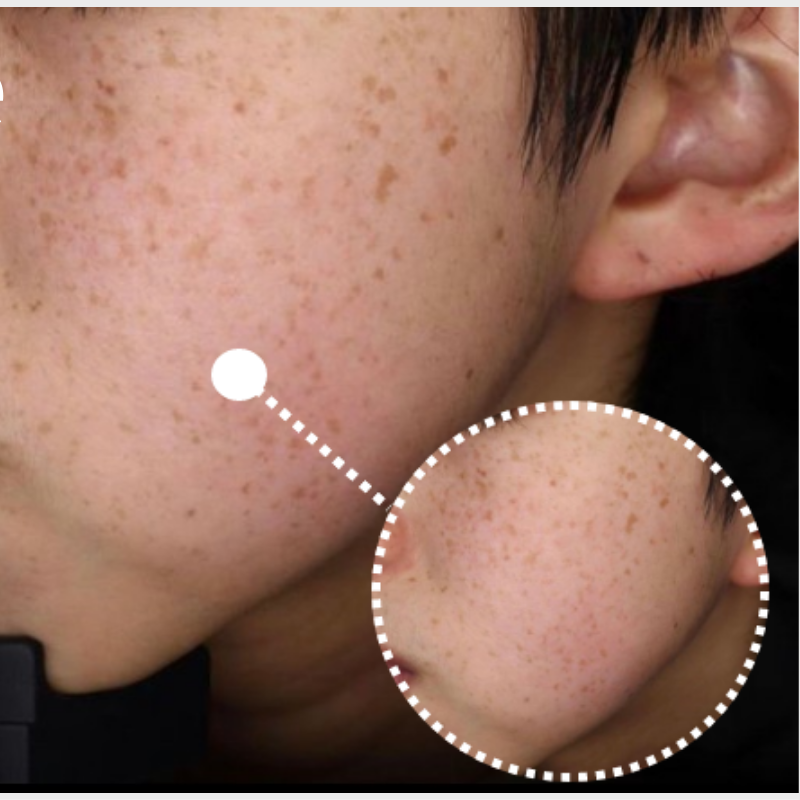 フォトフェイシャル 施術前