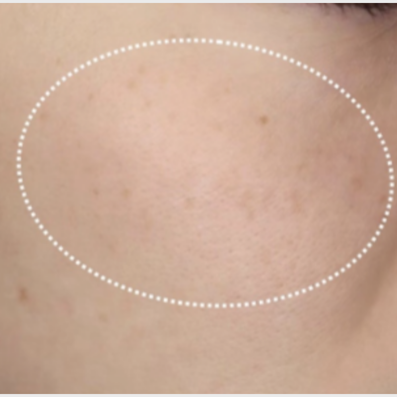 ピコトーニング 施術後