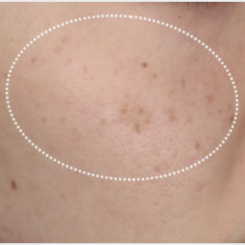 ピコトーニング 施術前