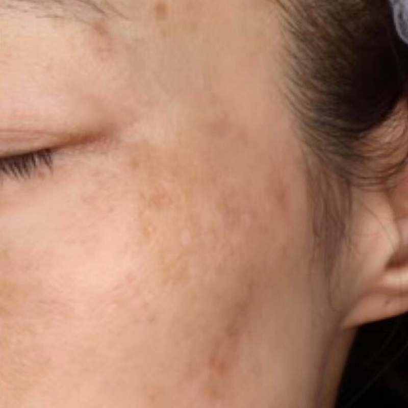 ピコスポット 施術後