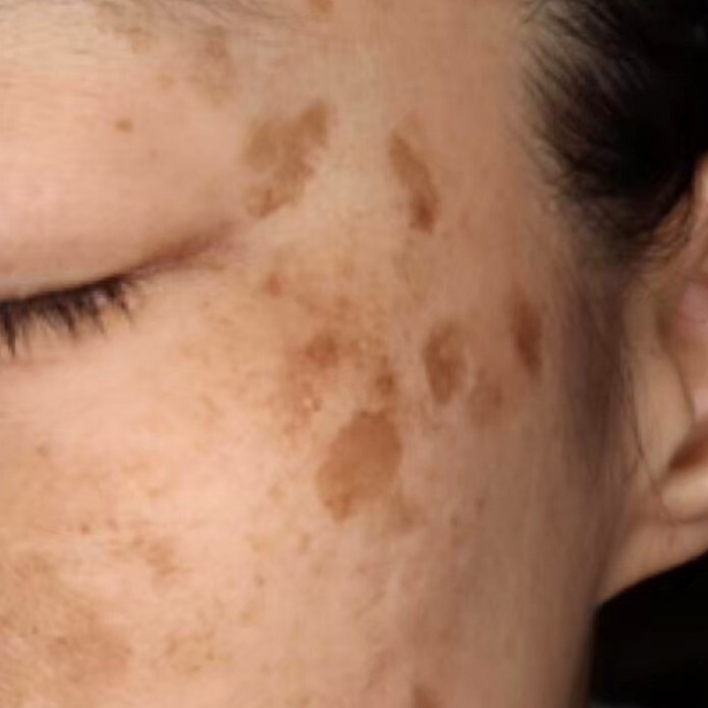 ピコスポット 施術前