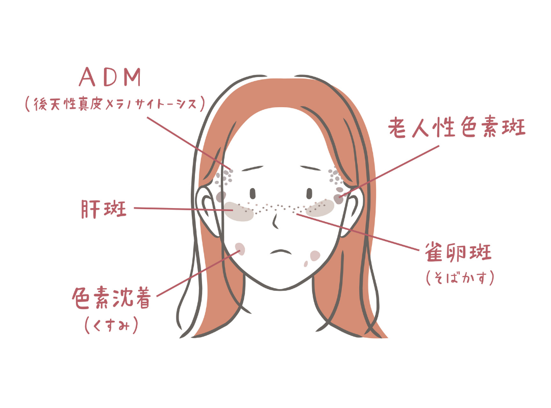 シミの種類：老人性色素斑・肝斑・そばかす・ADM・色素沈着