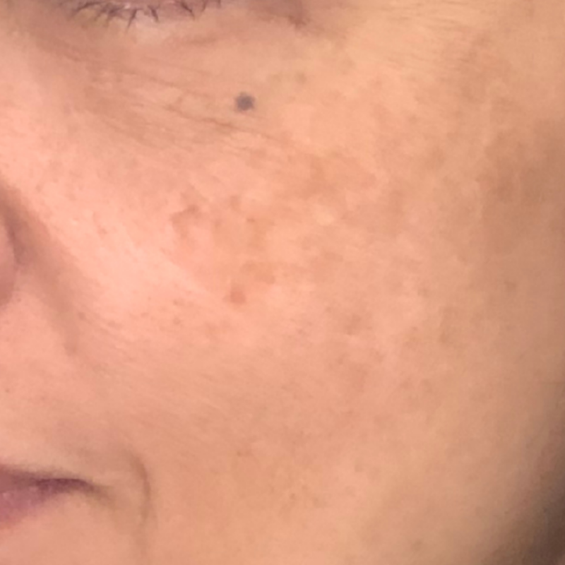 スネコス 施術後