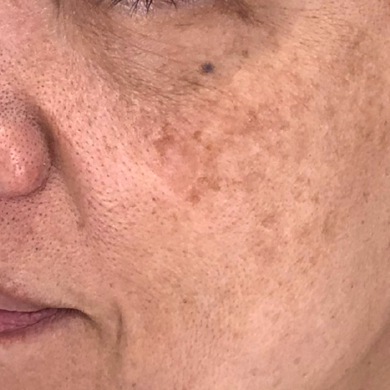 スネコス 施術前