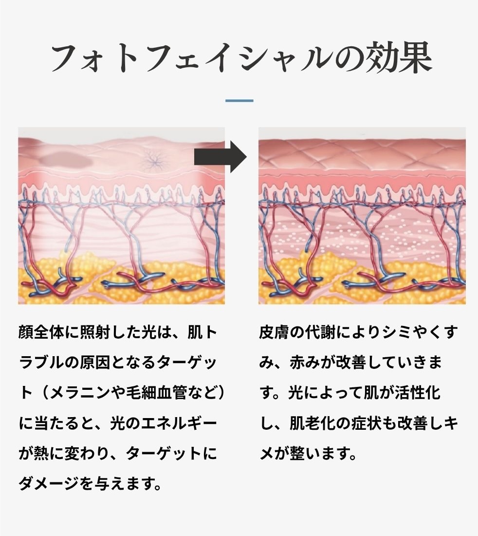 フォトフェイシャルの効果（光がターゲットに作用し、代謝で改善する仕組み）