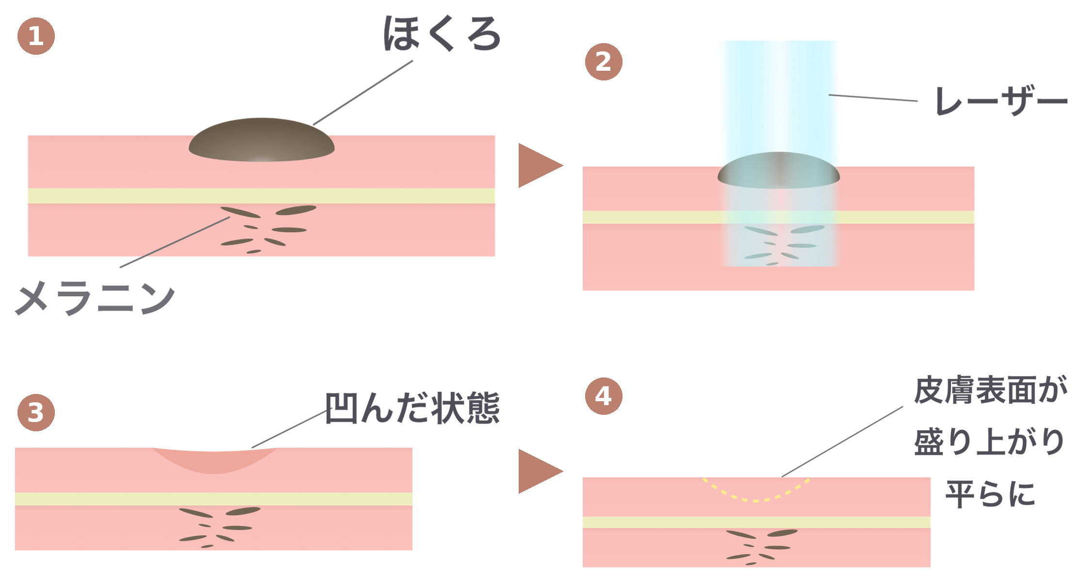 CO2レーザーのメカニズム（4ステップ）