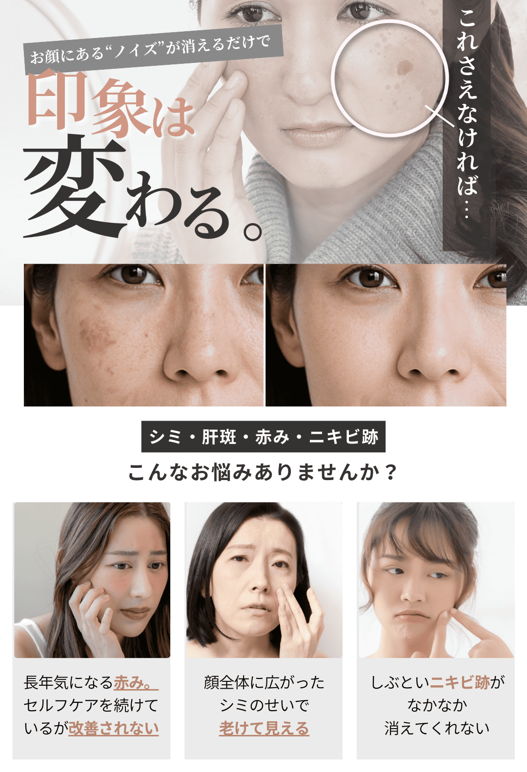 シミ・肝斑・赤み・ニキビ跡などのお悩み