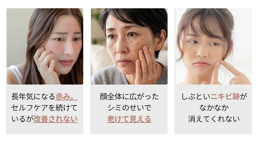 シミ・肝斑・赤み・ニキビ跡などのお悩み