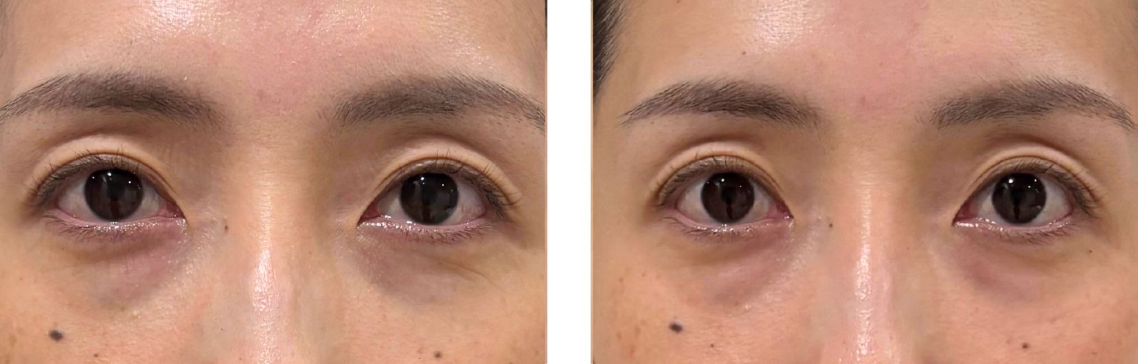 フォトナアイによる目元治療の症例写真・正面