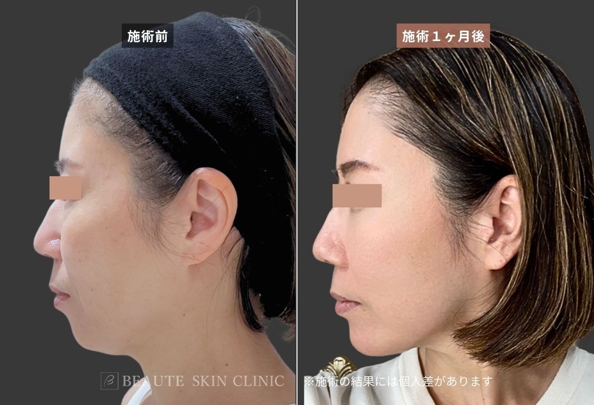 ヒアルロン酸6本の施術前と施術後の症例写真