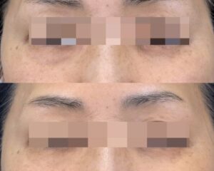 サーマニードルクマ Orbital Septa Mode 症例01
